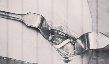 तीन साल के बच्चे की आंत में फस गई थी लॉलीपॉप की डंडी, सांचौर के मेडिपल्स हॉस्पिटल के डॉक्टर्स ने सफल ऑपरेशन कर दी राहत